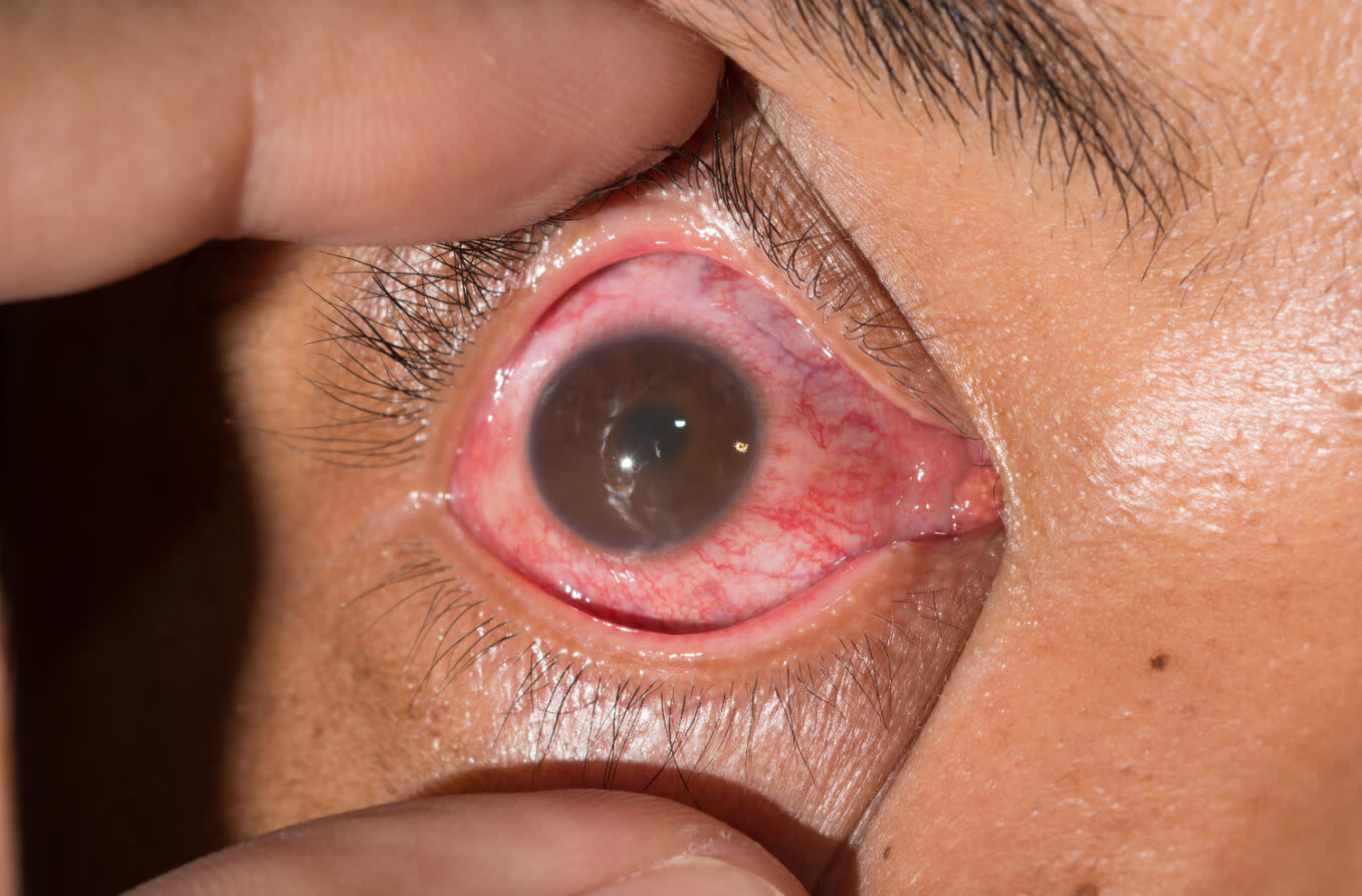 Retina e uveíte